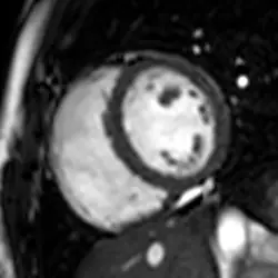 Animated cardiac MRI short-axis cine of the left ventricle