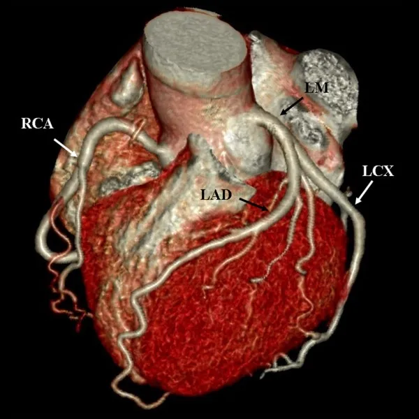 Cardiac CT
